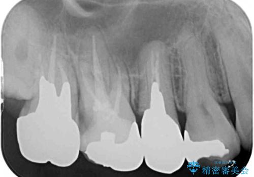 放置して悪化してしまったむし歯を早めに対応 セラミッククラウンによるむし歯治療の治療前