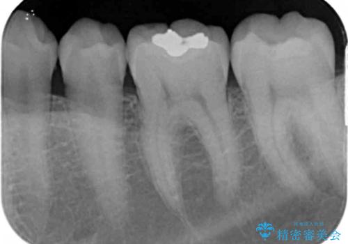 「セラミックインレー」目立つ下顎の銀歯を白くしたいの治療前