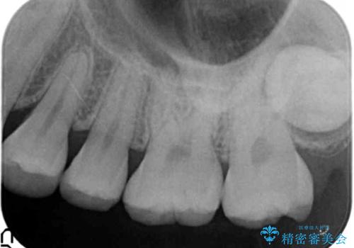 気づかなかった奥歯のう蝕 セラミックインレー 20代女性の治療前
