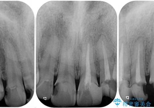 むし歯だらけの前歯をきれいにしたい オールセラミッククラウンによる審美歯科治療の治療前