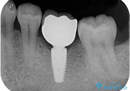 インプラントによる咬合機能回復の治療後