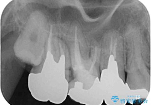 放置して悪化してしまったむし歯を早めに対応 セラミッククラウンによるむし歯治療の治療中