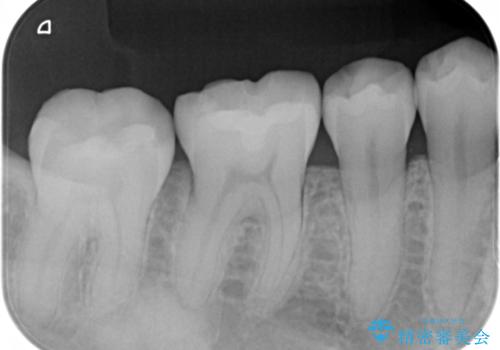 銀歯を白くしたい:矯正後に綺麗なセラミックへの治療後