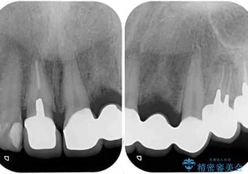 以前治療した歯が続々とむし歯に 全顎むし歯治療の治療後