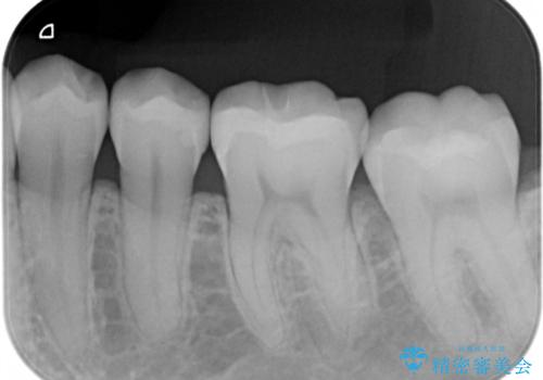 銀歯を白くしたい:矯正後に綺麗なセラミックへの治療後