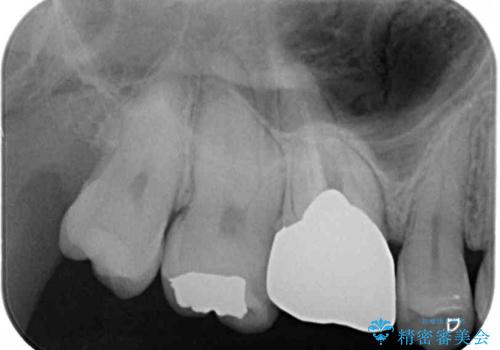 穴の空いてしまった奥歯　ゴールドインレーによるむし歯治療の治療前