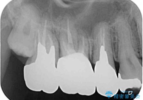 放置して悪化してしまったむし歯を早めに対応 セラミッククラウンによるむし歯治療の治療後