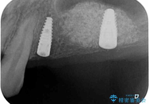 インプラント治療で達成する奥歯のしっかりとした咬合の治療前