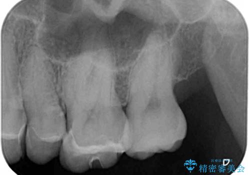 しみる奥歯 セラミッククラウンによるむし歯治療の治療前