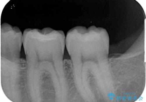 「セラミックインレー」目立つ下顎の銀歯を白くしたいの治療後