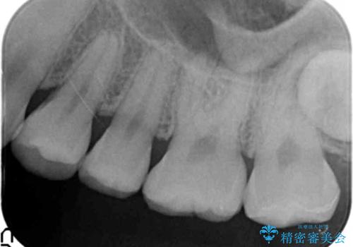 気づかなかった奥歯のう蝕 セラミックインレー 20代女性の治療後