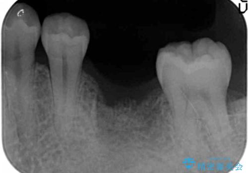 インプラントによる咬合機能回復の治療前