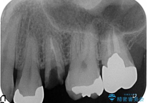 ソケットリフト 骨が薄い上の奥歯のインプラント 50代男性の治療前
