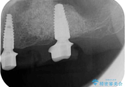 インプラント治療で達成する奥歯のしっかりとした咬合の治療中