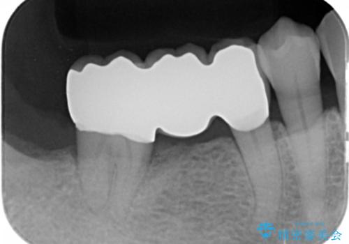 60代男性　奥歯のブリッジ　倒れこんでいる奥歯を部分矯正の治療後