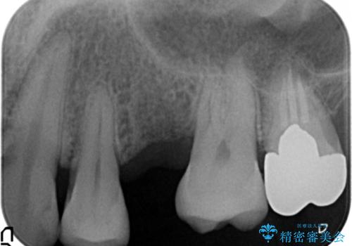 ソケットリフト 骨が薄い上の奥歯のインプラント 50代男性の治療前