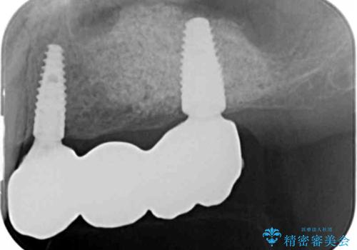 インプラント治療で達成する奥歯のしっかりとした咬合の治療後