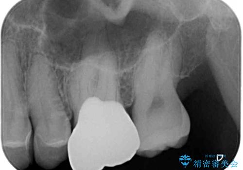しみる奥歯 セラミッククラウンによるむし歯治療の治療後