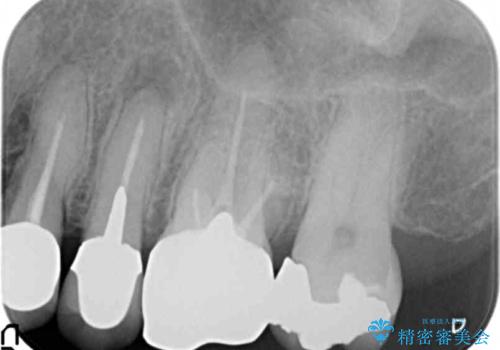 銀歯がノドに飛んできたことがトラウマ ラバーダムをして治療 50代女性の治療前