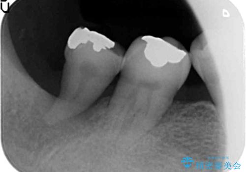 60代男性 奥歯のブリッジ 倒れこんでいる奥歯を部分矯正の治療前