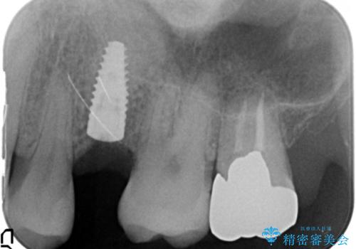 ソケットリフト　骨が薄い上の奥歯のインプラント　50代男性の治療中