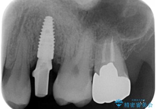 ソケットリフト　骨が薄い上の奥歯のインプラント　50代男性の治療中
