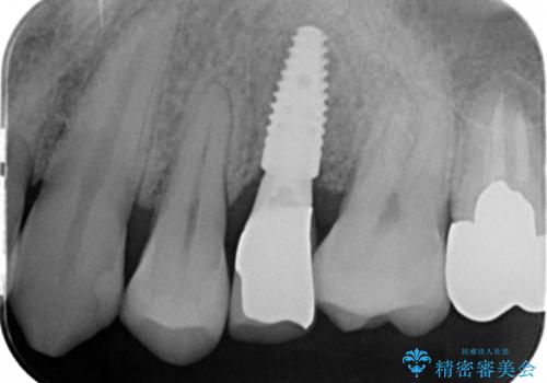 ソケットリフト　骨が薄い上の奥歯のインプラント　50代男性の治療後