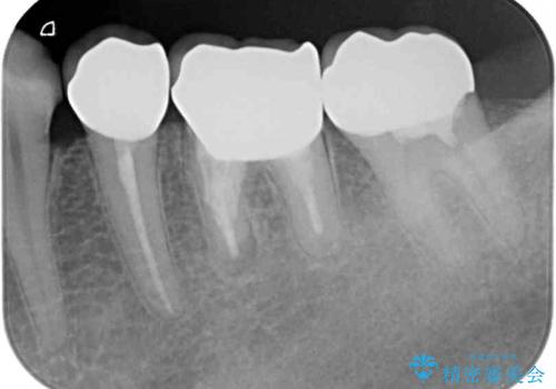 以前治療した歯が続々とむし歯に 全顎むし歯治療の治療後