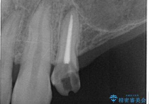 インプラント治療で達成する奥歯のしっかりとした咬合の治療前