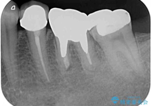 以前治療した歯が続々とむし歯に 全顎むし歯治療の治療前
