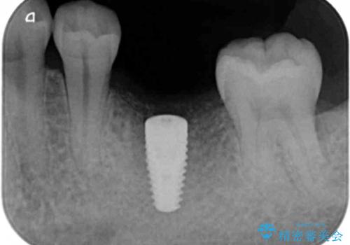 インプラントによる咬合機能回復の治療中