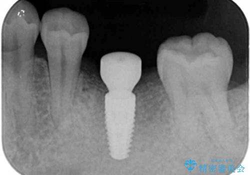 インプラントによる咬合機能回復の治療中
