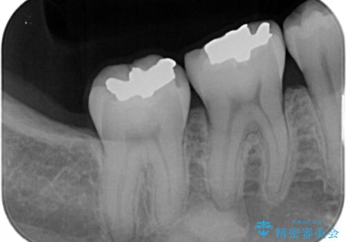 銀歯を白くしたい:矯正後に綺麗なセラミックへの治療前