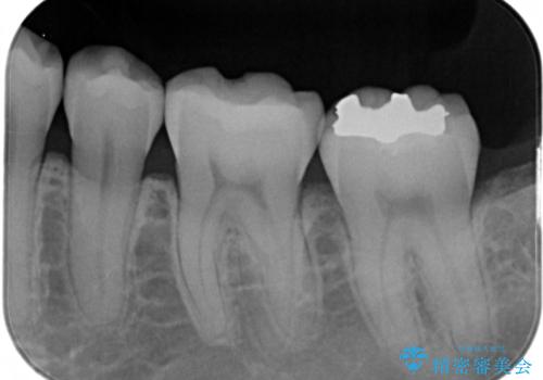 銀歯を白くしたい:矯正後に綺麗なセラミックへの治療前