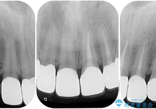 むし歯だらけの前歯をきれいにしたい オールセラミッククラウンによる審美歯科治療の治療後