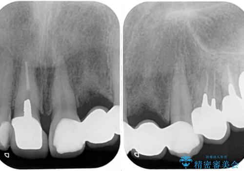 以前治療した歯が続々とむし歯に 全顎むし歯治療の治療前
