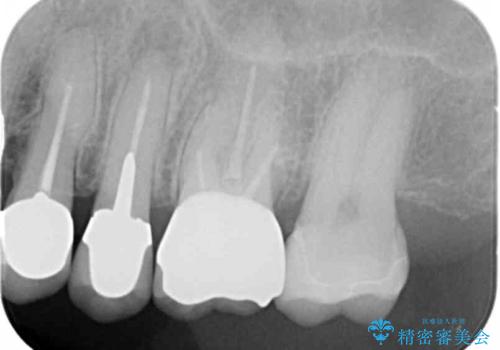 銀歯がノドに飛んできたことがトラウマ ラバーダムをして治療 50代女性の治療後