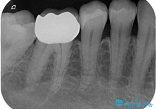 インレーとクラウン 銀歯をセラミックにやりかえの治療後