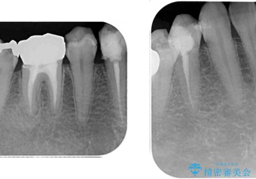 以前治療した歯が続々とむし歯に 全顎むし歯治療の治療前