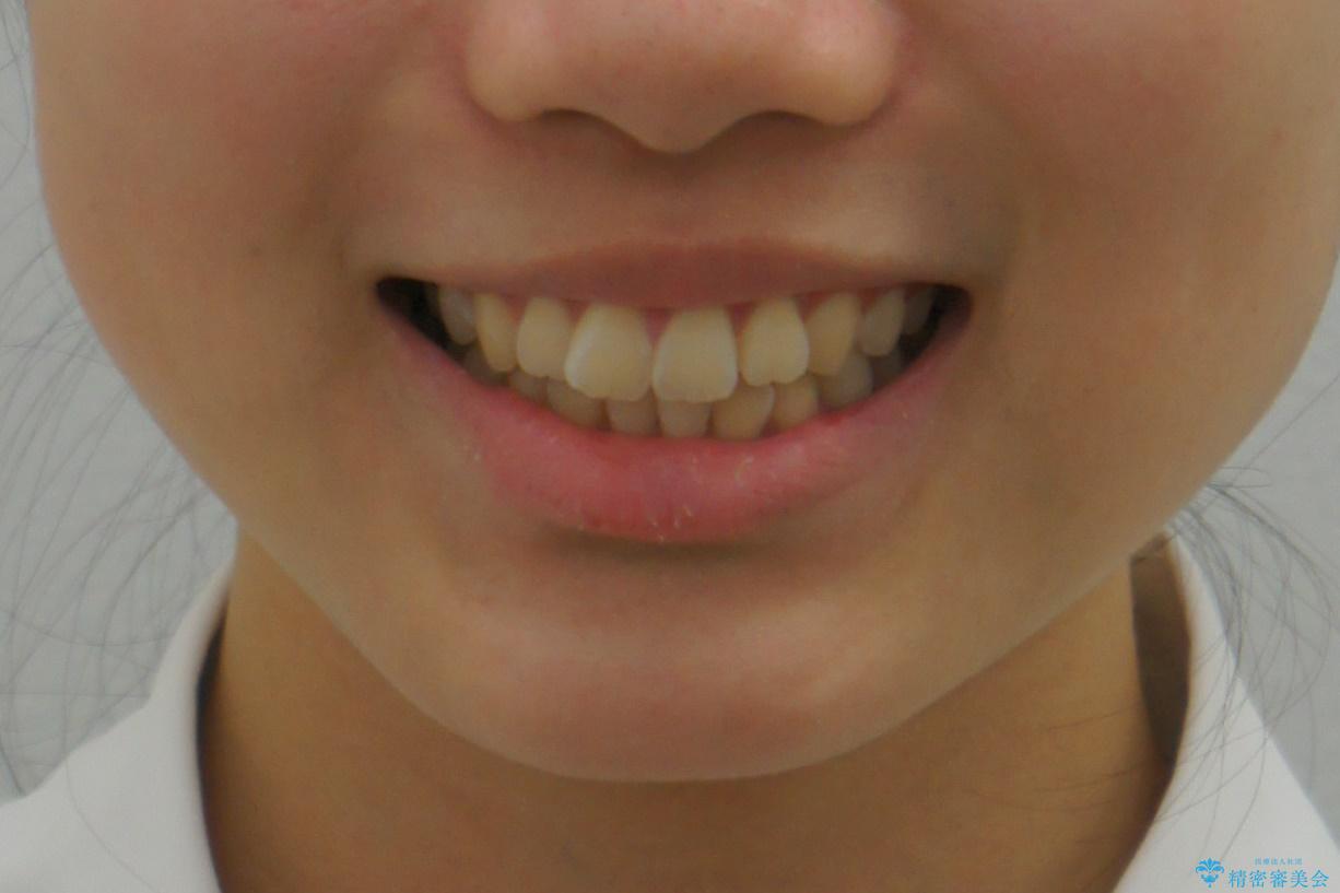 出っ歯　軽度のがたつき　インビザラインでの治療前（顔貌）