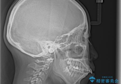 突出した口元が気になる ハーフリンガル装置による抜歯矯正の治療前