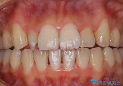 矯正中のPMTC60分コースの症例 治療前