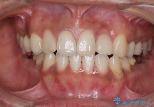 以前治療した歯が続々とむし歯に　全顎むし歯治療の症例 治療前