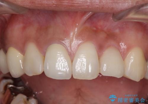 以前治療した歯が続々とむし歯に 全顎むし歯治療の治療前