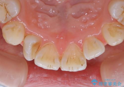 矯正中のPMTC60分コースの治療前