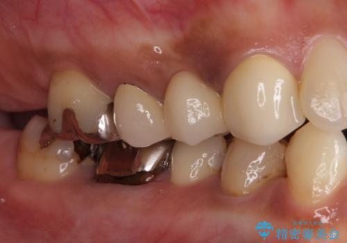 以前治療した歯が続々とむし歯に 全顎むし歯治療の治療前