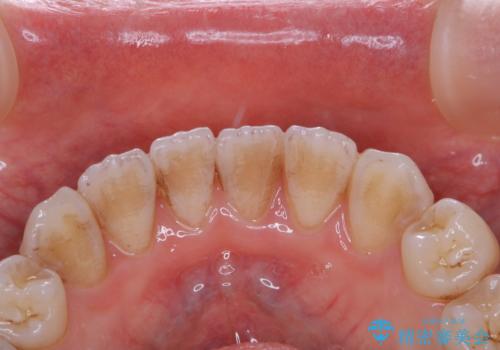 矯正中のPMTC60分コースの治療前