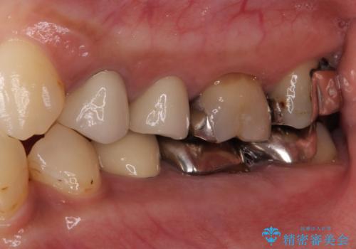 以前治療した歯が続々とむし歯に 全顎むし歯治療の治療前