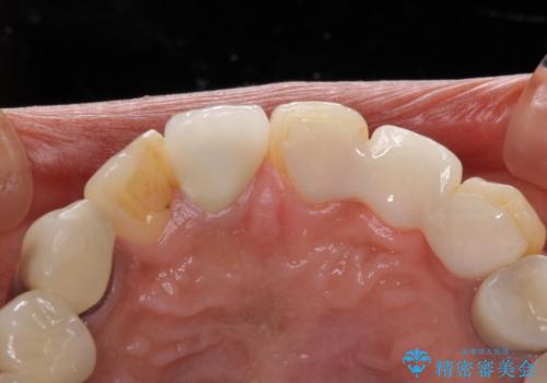 以前治療した歯が続々とむし歯に　全顎むし歯治療の治療前