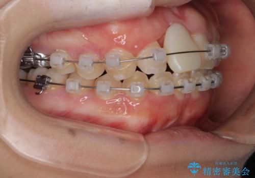 怪我をして不格好な前歯 矯正治療とインプラント補綴治療の治療中